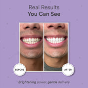 Astra Teeth Whitening Strips