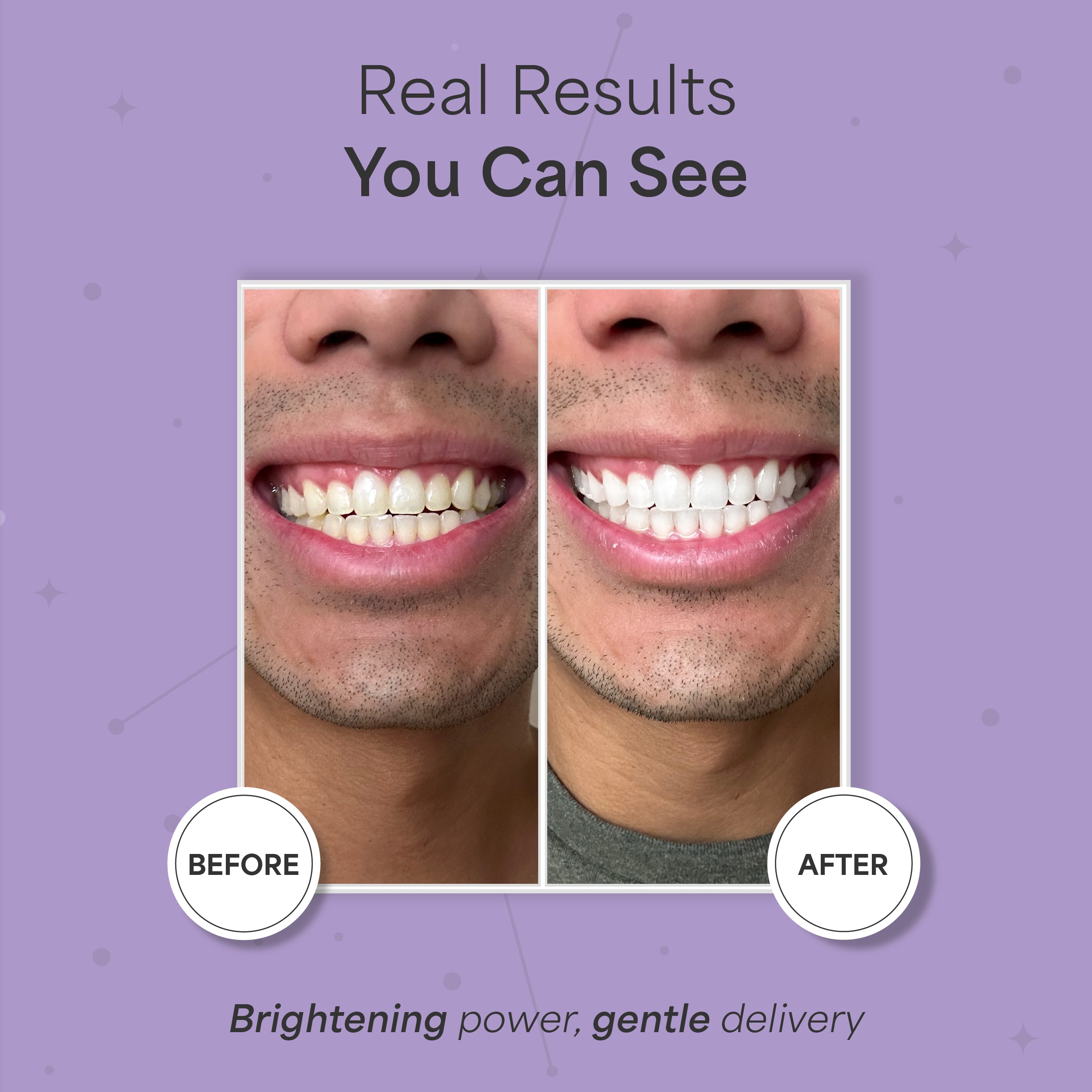 Astra Teeth Whitening Strips