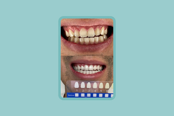 All-Natural Teeth Whitening Kit